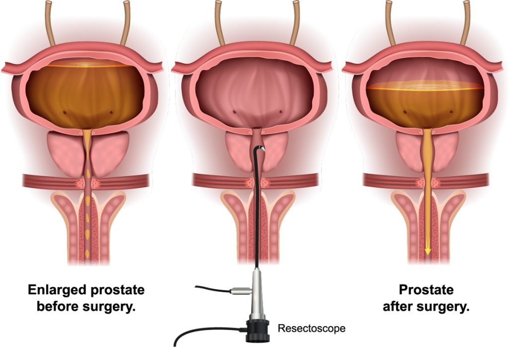 enlarged prostate treatments